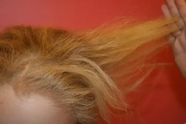 得了毛襄角化症的人能结婚吗