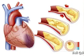 冠心病的解剖基础——最全的冠脉血管图解图片