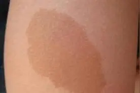 未解之谜一一胎记图片