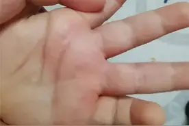 孩子手上起很痒的小疙瘩，是什么？怎么办？图片