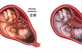 八个月宝宝胎死腹中！可怕的“脐带扭转”，医生都吓出一身冷汗图片
