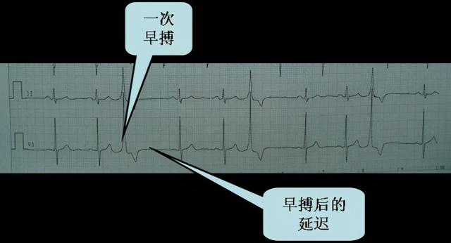 什么是窦性心律？什么是早搏？需做哪些检查？要治疗吗？如何治？