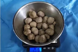 84岁老人体内取出22颗“鸽子蛋”结石图片