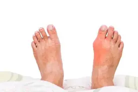 痛风发作受尽折磨，如果做到以下几点，痛苦有效缓解图片