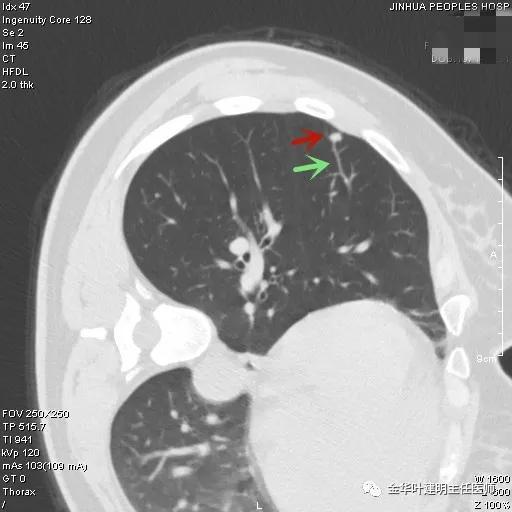 叶建明谈结节：检查发现肺实性结节怎么办？个人版实用指南