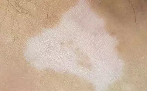角质角化型脚气怎么根治