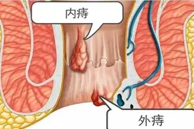 不疼的痔叫内痔，当它脱出肛门外时，就只剩这种办法能帮到你了图片