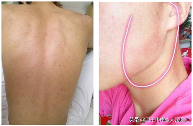 鸡皮肤在脖子上用什么药