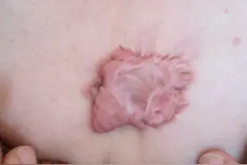 前胸瘢痕疙瘩要怎么治疗？图片