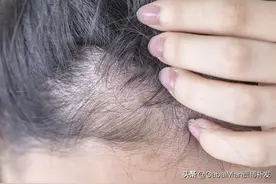 发际线的重要性，你知道吗？发际线过高如何拯救图片