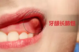 牙龈长脓包：危险！停止自己刺破图片