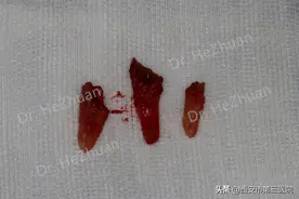 【智齿变废为宝】神奇的自体牙移植术图片