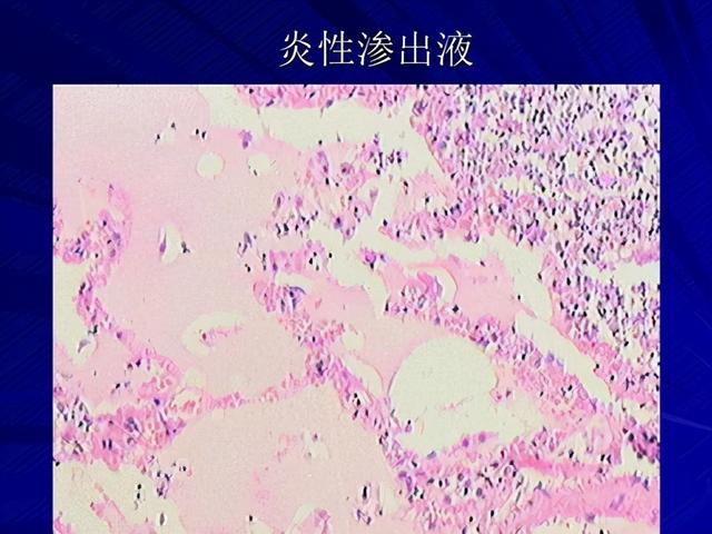 持久豆状角化病