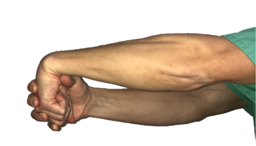 网球肘的治疗与康复(二)