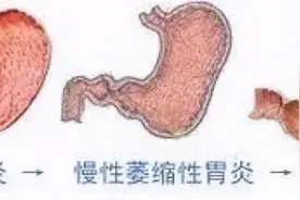 从胃炎到胃癌，一般需要多长时间？医生：有3种症状，尽量不要拖图片