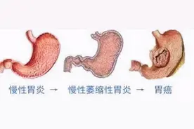从胃炎到胃癌，一般需要多长时间？医生：有3种症状，尽量不要拖图片