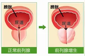 「医疗在线」西北首例“经尿道前列腺绿激光汽化术”在西安大兴医院开展图片