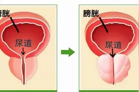 「医疗在线」西北首例“经尿道前列腺绿激光汽化术”在西安大兴医院开展图片