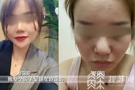 女子整形后鼻子歪了 院方：肋骨还有，可以修复！|解忧帮图片