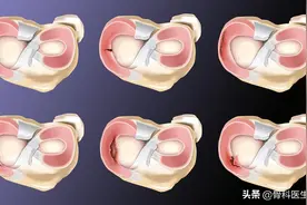 半月板损伤可以治愈吗？半月板损伤的最好治疗方法有哪些？图片