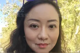 52岁大妈全脸整容一个月，朋友说年轻十岁换了一张脸图片