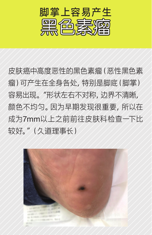 角化过度型足癣脂肪肝