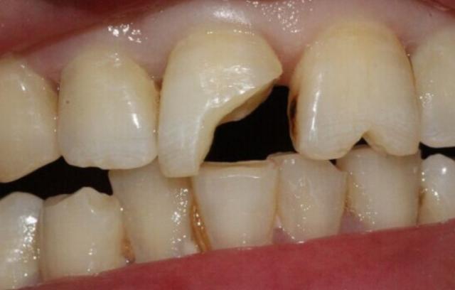 门牙缺了一点怎么办