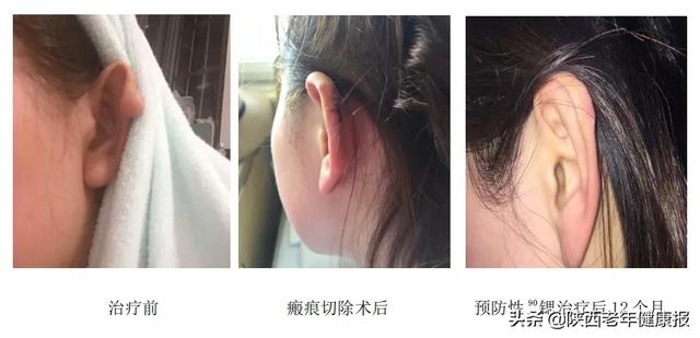 汗孔角化专用 汗孔角化专用