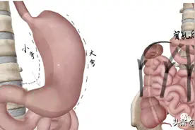 【医者叮嘱】长期反复胃痛万万不可忽视，小心溃疡穿孔！图片