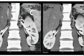 陕西省中医医院泌尿外科成功切除一例巨型肾肿瘤图片