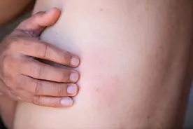 皮炎、湿疹、荨麻疹您分得清吗？别以为孩子身上长疙瘩就是湿疹图片