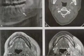 牙源性化脓性颌骨骨髓炎影像诊断图片