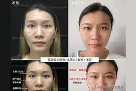 一块骨头把温柔脸变凶脸？她颧骨高如山，不经磨骨之痛却收获了美图片