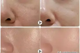 没做过“水光针”的人，听我谈谈真实的感受图片