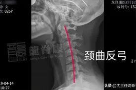 脊椎检查体检报告，你会看吗？图片
