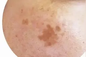 轻松祛斑根本不可能！找准原因长期坚持，才能将它逐步淡化图片