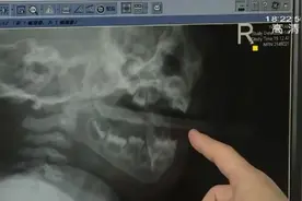 2岁男童咬鞋撑玩耍，不慎插入口中直抵鼻咽！妈妈们注意，幼童监护不容闪失图片