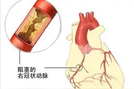 医生是如何给冠心病患者做冠脉造影的？一文看懂导管从手臂进入心脏的过程图片