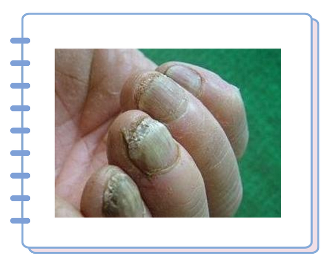 得了灰指甲，反复发作难根治？一次性介绍7种药，总有一款适合你