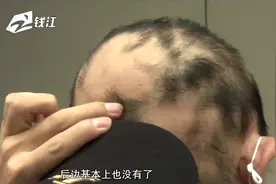 为追求完美发际线小伙植发 一年后不仅发际线没了 后脑勺也秃了视频封面