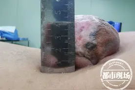 比拳头还大！女孩腰部长了一怪包，20年来都无法平躺和行走图片