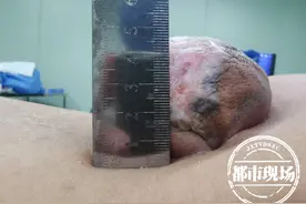 比拳头还大！女孩腰部长了一怪包，20年来都无法平躺和行走图片