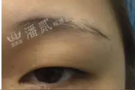 “上天不公平！肿眼泡/肿泡眼要跟我一辈子？”提防后天上睑凹陷图片