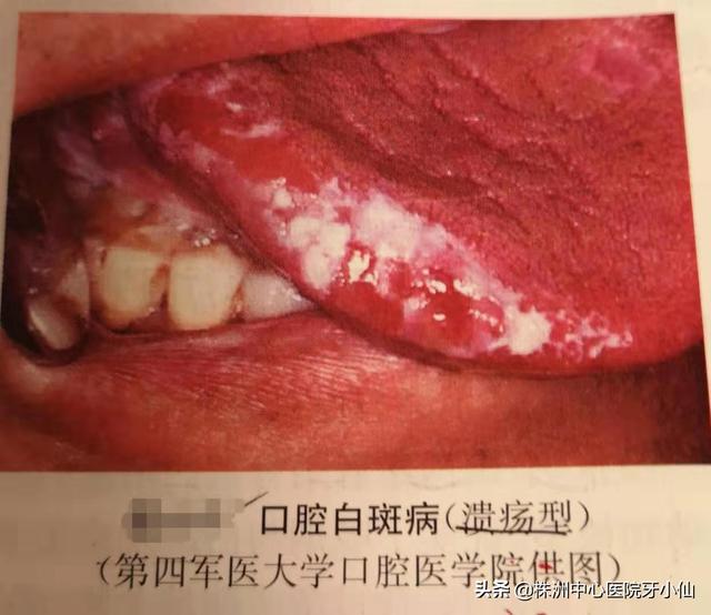 口腔粘膜角化是什么病