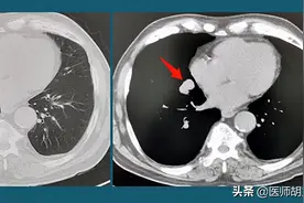 陈女士肺结节缩小了，医生却说是癌症，为啥肺结节缩小了还是癌症图片