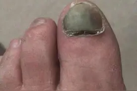 甲下积血怎么办？图片