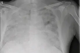 晚期肺癌患者相继出现肝损伤及重症肺炎表现，如何多学科联手应对图片