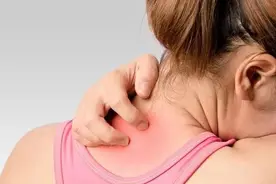 糖吃太多？天气潮湿？背上长痘到底怎么肥事图片