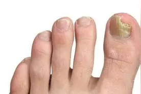 很多医院治不好灰指甲？其实很容易治，这种“特效药”治好不复发图片