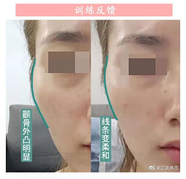 颧骨外凸与高低，两侧颧骨不对称，脸型又太凸，颧骨怎么运动改善